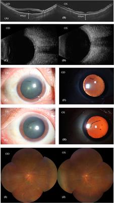 VKH-like uveitis during donafenib therapy for hepatocellular carcinoma: a case report and review of the literature